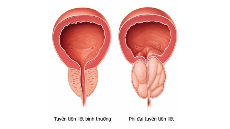 Bệnh lý thường gặp ở nam giới trên 50 tuổi