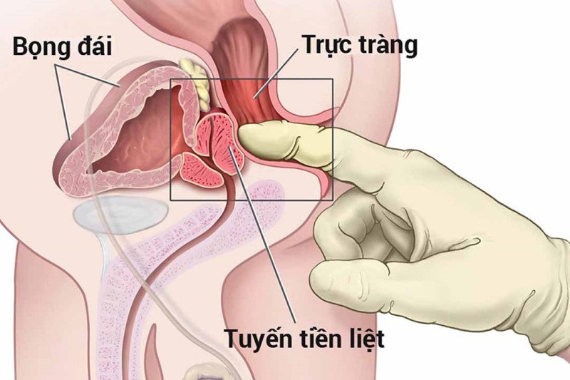 Tuyến tiền liệt có chức năng quan trọng trong khả năng sinh sản ở nam giới