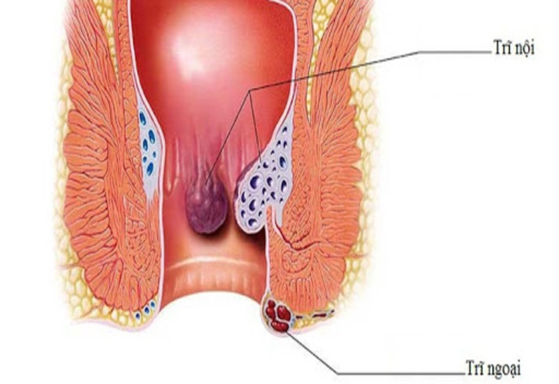 Táo bón lâu ngày có thể gây bệnh trĩ