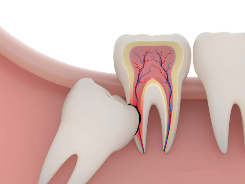 Do thiếu không gian mọc mà răng khôn thường mọc lệch, xô đẩy vào răng khác