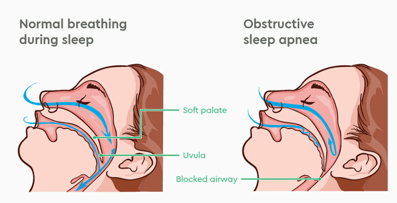 Giải đáp câu hỏi: Ngưng thở tắc nghẽn khi ngủ là gì?