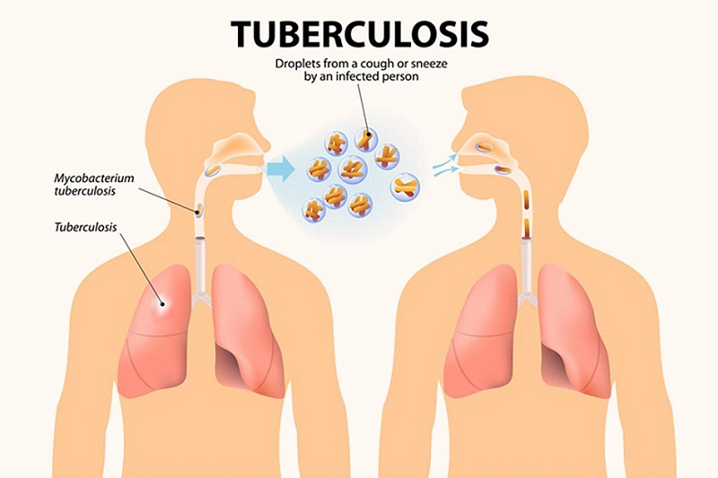 Khi tiếp xúc với người bị lao phổi thì nguy cơ lây nhiễm rất cao