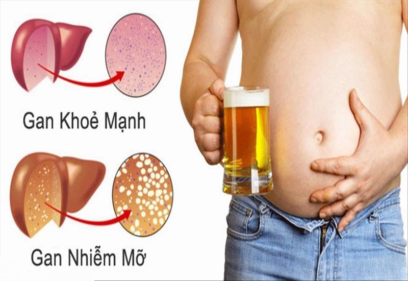 Gan nhiễm mỡ có thể dẫn đến biến chứng nguy hiểm