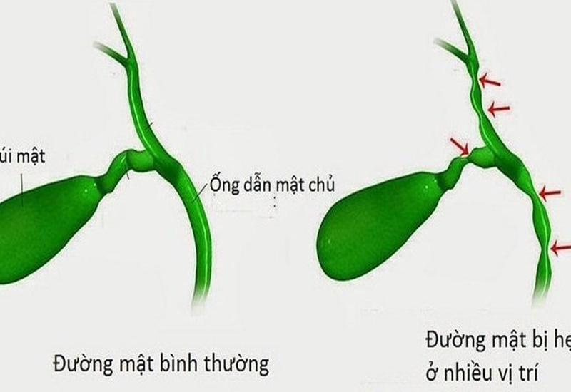 Cần thực hiện phẫu thuật để điều trị teo đường mật