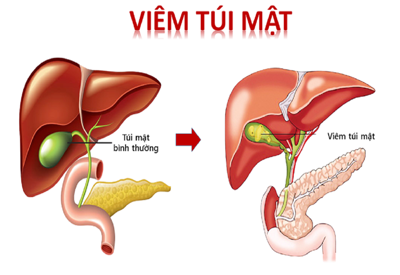 Viêm túi mật dẫn đến nôn dịch mật