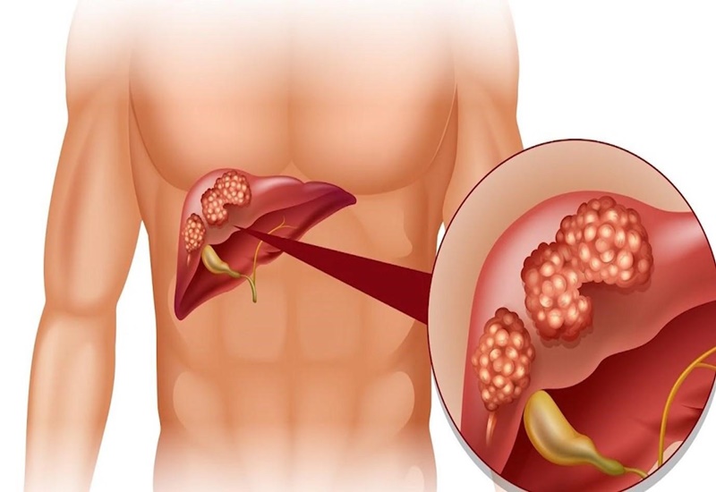 Bệnh gan có thể gây nhiều biến chứng nguy hiểm