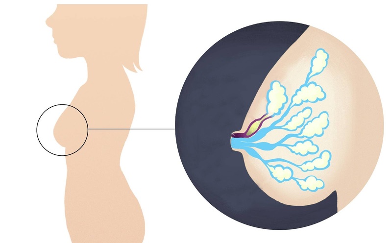 Tắc tia sữa là tình trạng nhiều mẹ nuôi con bằng sữa mẹ gặp phải