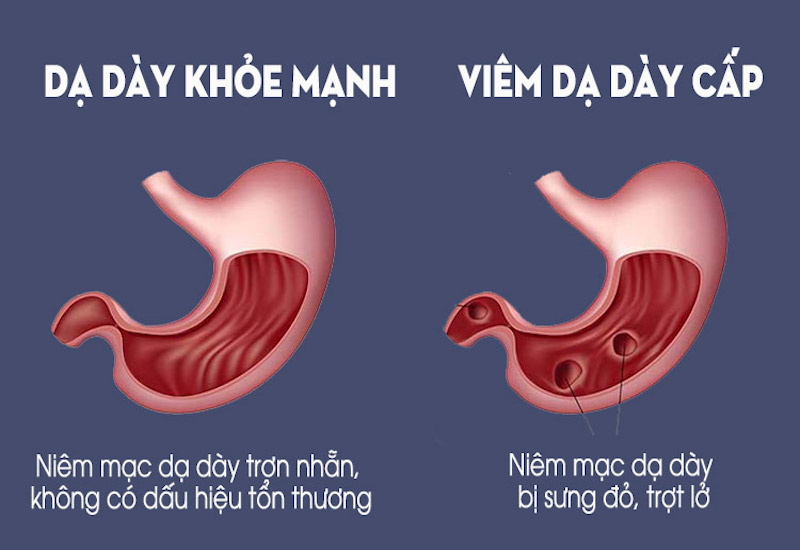 Niêm mạc dạ dày khi khỏe mạnh và khi bị viêm dạ dày cấp