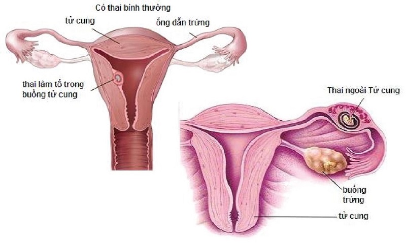 Thai ngoài tử cung có thể khiến mẹ bầu bị căng tức và đau bụng