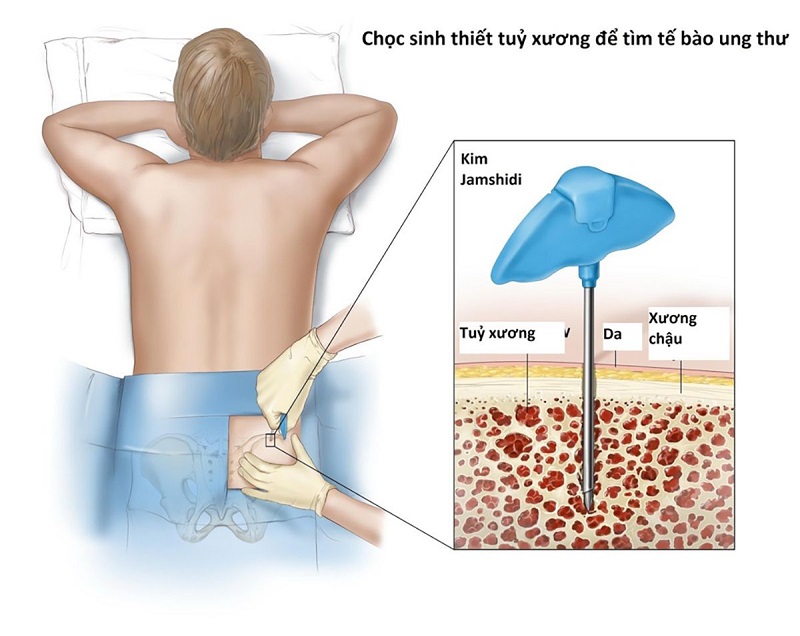 Sinh thiết xương giúp chẩn đoán u xương ác tính