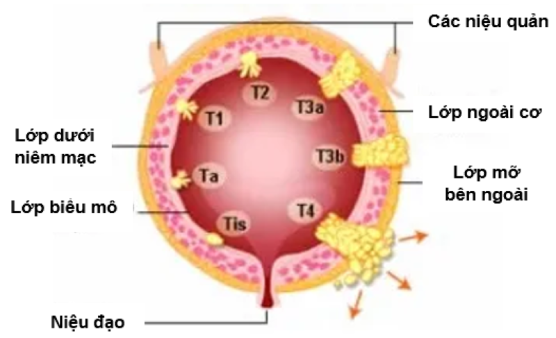 Hình 1. Các giai đoạn của ung thư bàng quang (nguồn: Home Remedy, 2019).