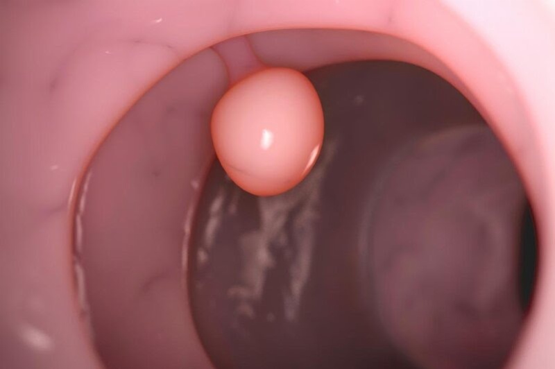 Polyp đại tràng xuất hiện phổ biến