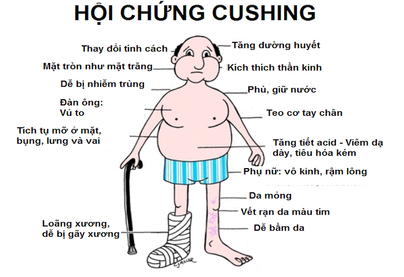 Biểu hiện của hội chứng Cushing - biến chứng có thể xảy ra nếu dùng thuốc nhỏ mũi sai cách