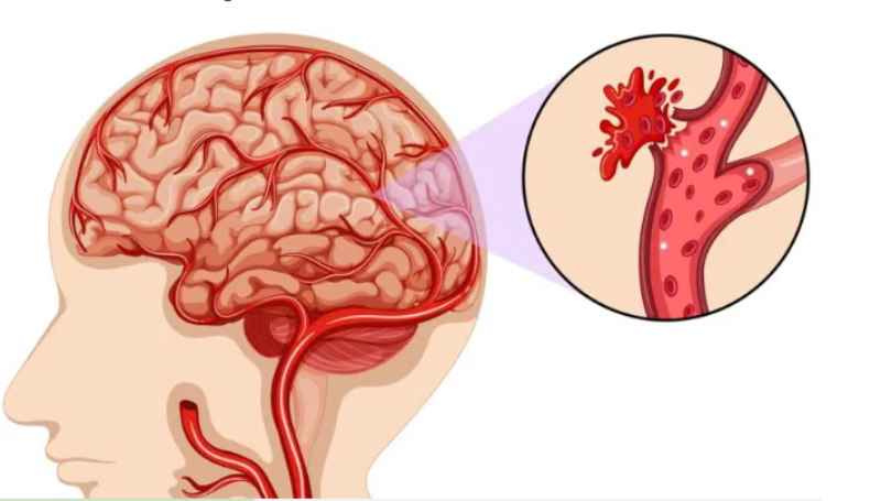 Vỡ động mạch sau đó gây chảy máu trong não