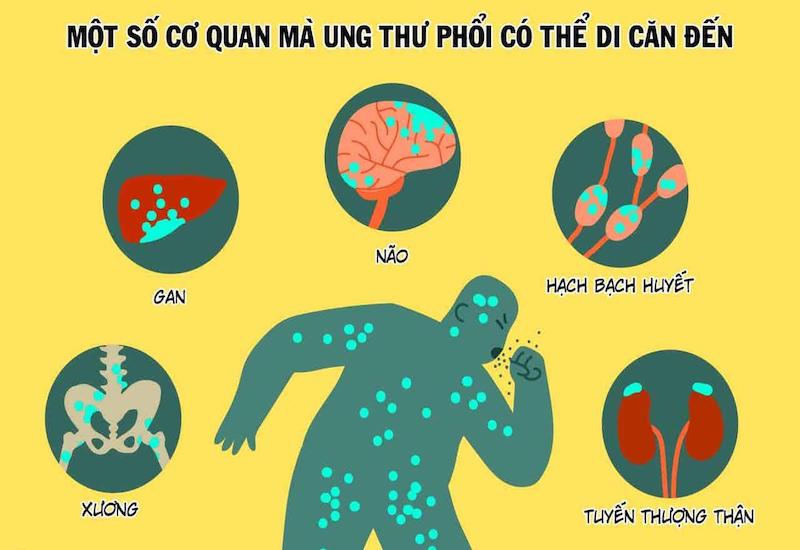 Những cơ quan thường bị ung thư phổi giai đoạn cuối tìm đến