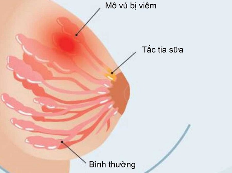 Có rất nhiều nguyên nhân khiến mẹ bỉm bị tắc tia sữa sau sinh 