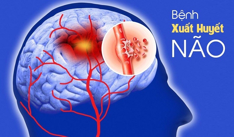 Hình ảnh bệnh xuất huyết não