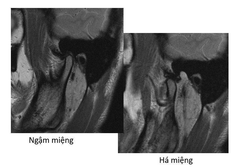 Hình ảnh ảnh chụp MRI thái dương hàm tư thế ngậm và há miệng tại MEDLATEC