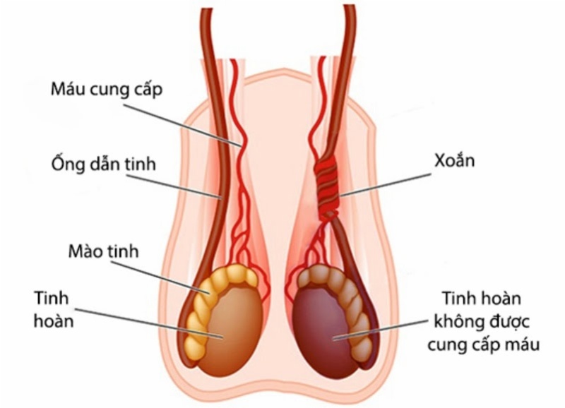 Tình trạng xoắn tinh hoàn có thể làm xuất hiện khối u ở tinh hoàn