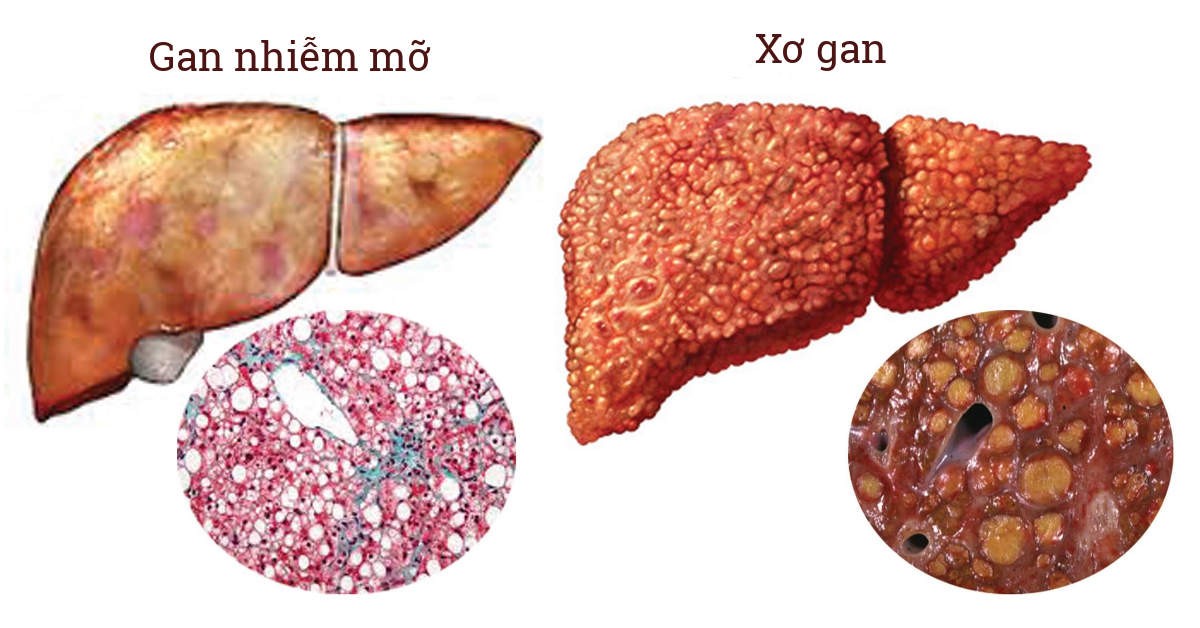 Mô tả hình ảnh gan nhiễm mỡ và xơ gan