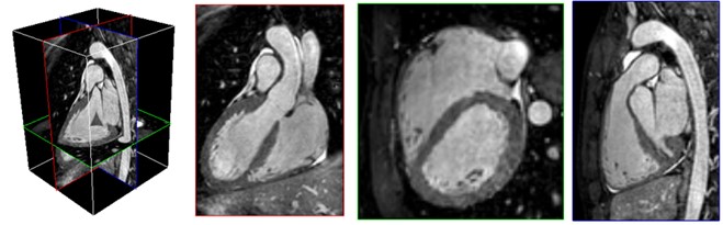 Chụp chuỗi xung động mạch vành (Whole heart 3D), thu tín hiệu theo nhịp thở của bệnh nhân