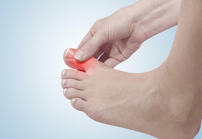 Bệnh Gout là tình trạng rối loạn chuyển hóa do nồng độ axit uric trong huyết tương quá cao