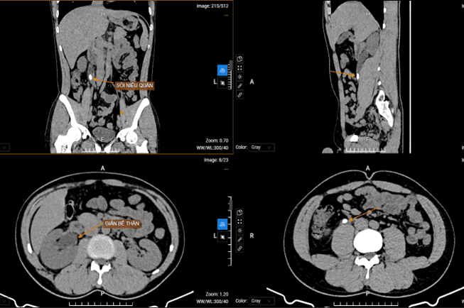 Chụp cắt lớp vi tính hệ tiết niệu