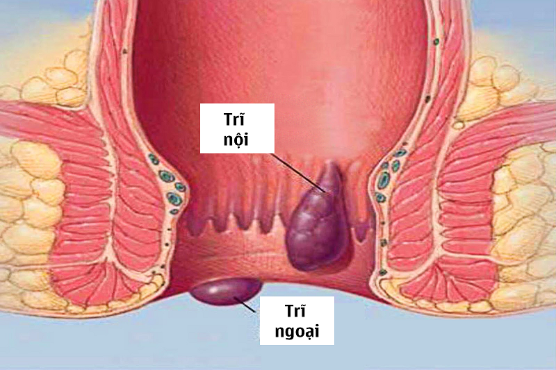 khám bệnh trĩ là khám những gì