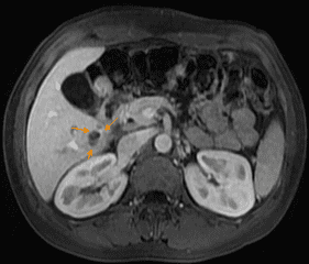 Chụp MRI gan mật