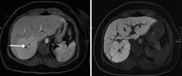 Chụp MRI gan mật