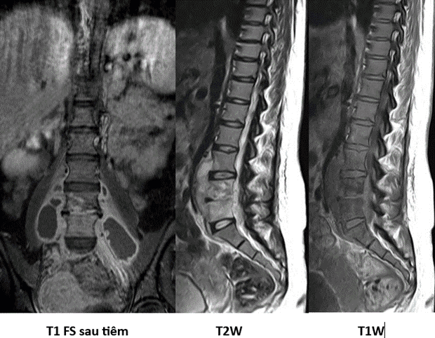 chụp mri lao xương