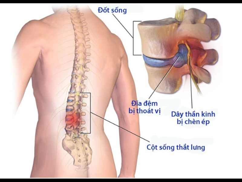 Thoát vị đĩa đệm là bệnh lý cột sống phổ biến hiện nay