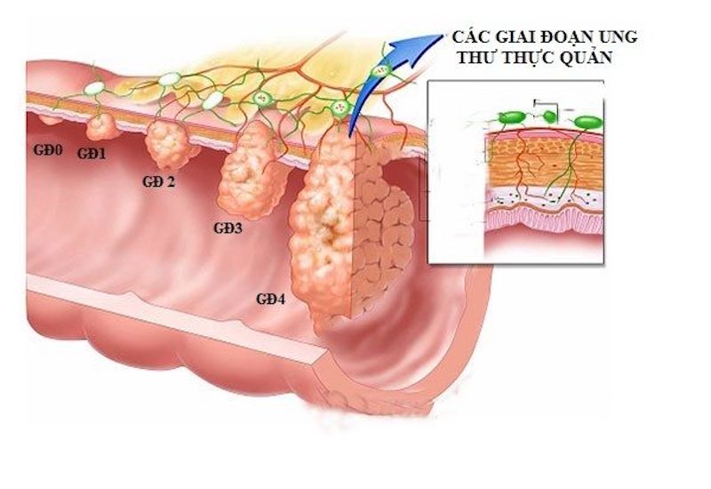 Các giai đoạn phát triển của ung thư thực quản