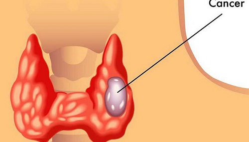 Khi nhận thấy những dấu hiệu bất thường bạn nên nghĩ đến việc siêu âm tuyến giáp