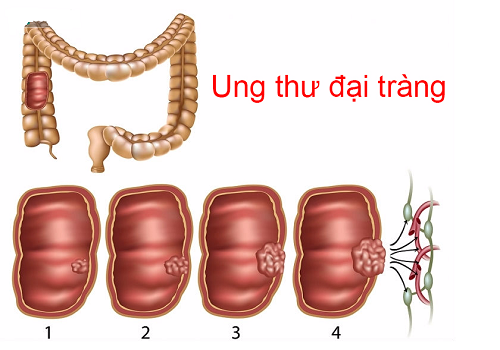 Siêu âm đại tràng tiết kiệm chi phí, an toàn cho người bệnh