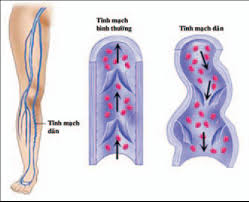 MEDLATEC điều trị suy giãn tĩnh mạch an toàn, hiệu quả