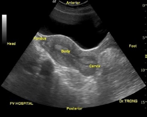 siêu âm tử cung giúp phát hiện những bệnh lý bất thường ở cơ quan sinh dục nữ