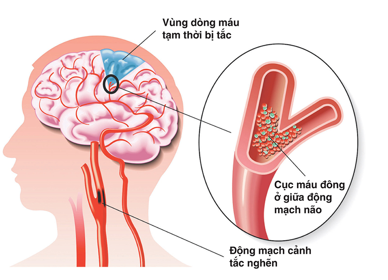 Bệnh mạch máu não là một trong những nguyên nhân dẫn đến tỷ lệ đột quỵ mỗi năm