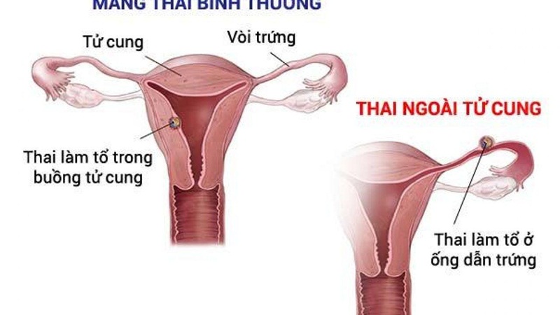 Hình ảnh mang thai ngoài tử cung