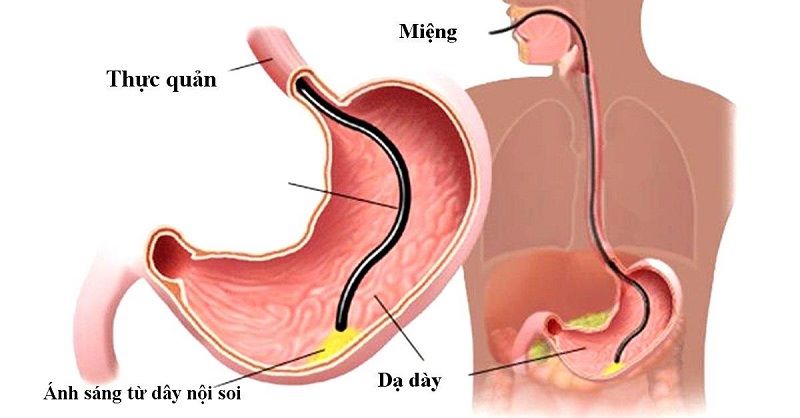 Công nghệ nội soi NBI được xem như một bước tiến lớn của nội soi tiêu hóa