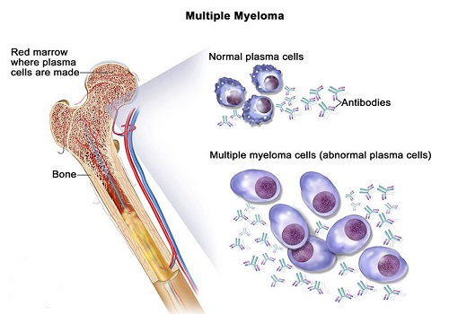 Beta2-microglobulin máu có thể được chỉ định ở một người đã được chẩn đoán bị đa u tủy xương