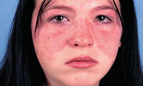 Bệnh lupus