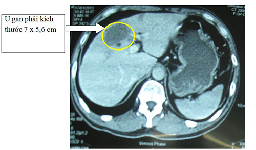 hình ảnh chụp cắt lớp gan giúp phát hiện những tổn thương ở gan