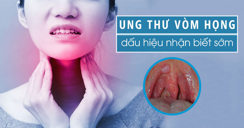 Ung thư vòm họng nếu bước vào giai đoạn di căn sẽ vô cùng nguy hiểm