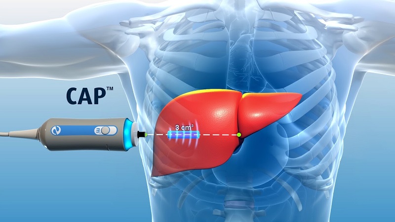 Thiết bị FibroScan, nguyên tắc hoạt động và cách thể hiện kết quả độ cứng của gan (Frulio N and Trillaud H 2013 [3]).