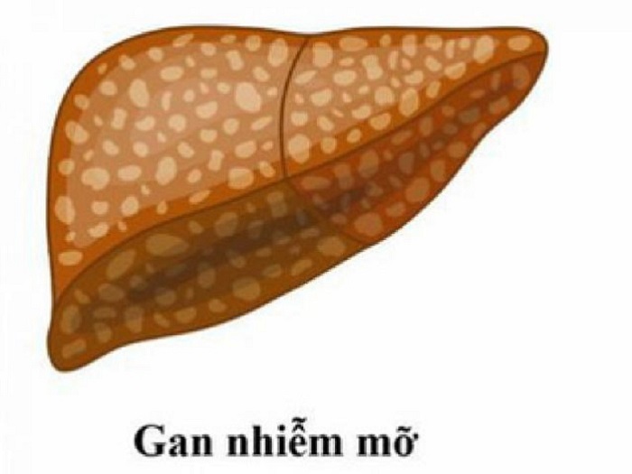 Lá gan bị nhiễm mỡ