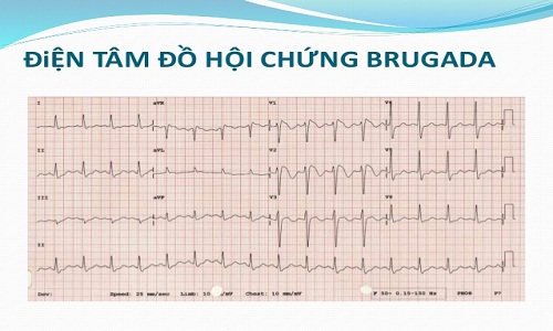 Ai dễ mắc hội chứng Brugada, lời khuyên từ chuyên gia MEDLATEC