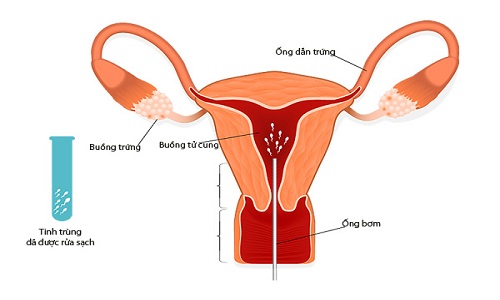 Kỹ thuật IUI tại Bệnh viện đa khoa MEDLATEC