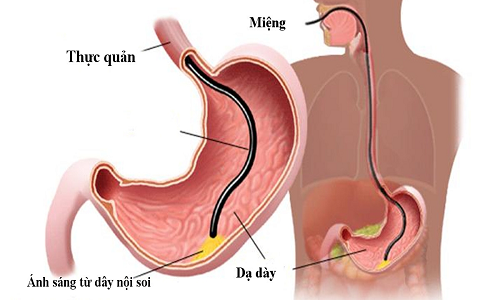 Ngày nay, càng nhiều người lựa chọn nội soi dạ dày không đau