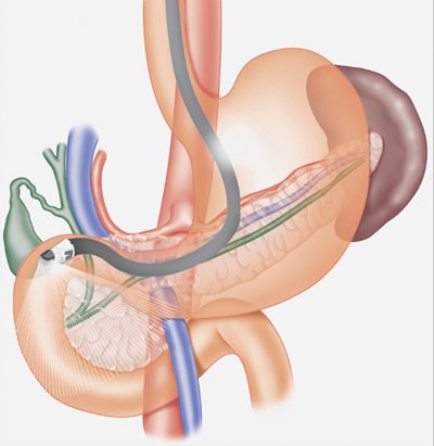 Siêu âm dạ dày giúp phát hiện những tổn thương ở dạ dày